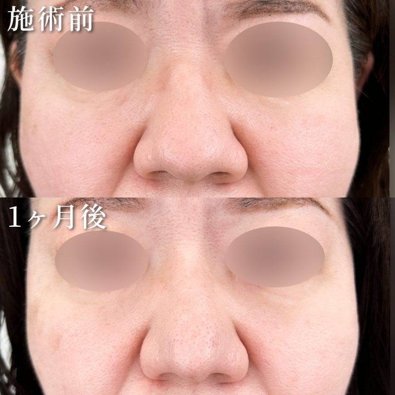 鼻尖形成(担当医:岡﨑 仁志 医師)の症例写真1
