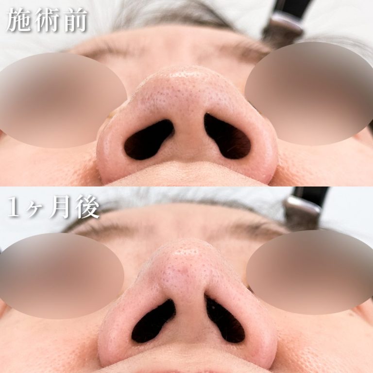 鼻尖形成(担当医:岡﨑 仁志 医師)の症例写真2