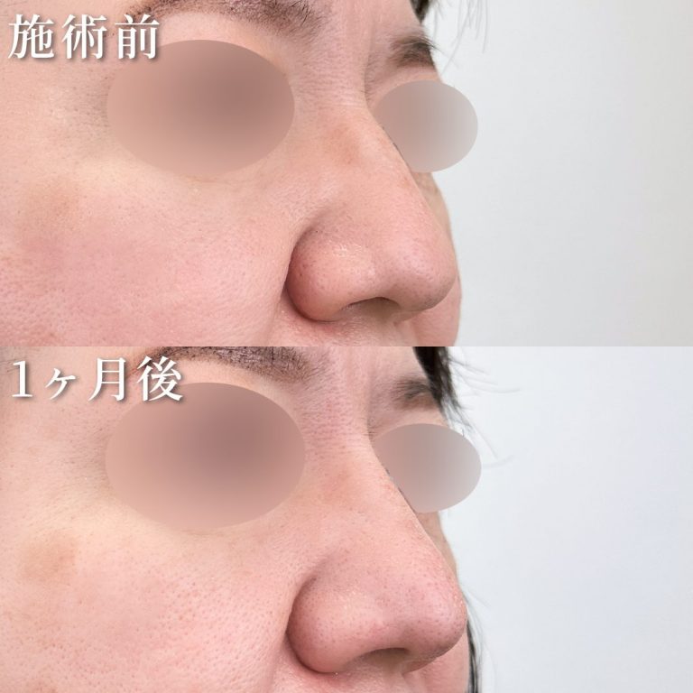 鼻尖形成(担当医:岡﨑 仁志 医師)の症例写真3
