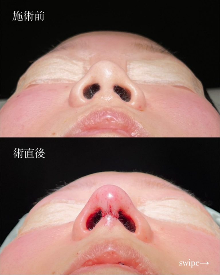 鼻プロテーゼ（隆鼻術）(担当医:寺西 宏王 医師)の症例写真2