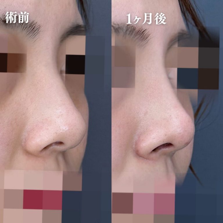 TCB式鼻先尖鋭術（だんご鼻解消）(担当医:大隈 宏通 医師)の症例写真2