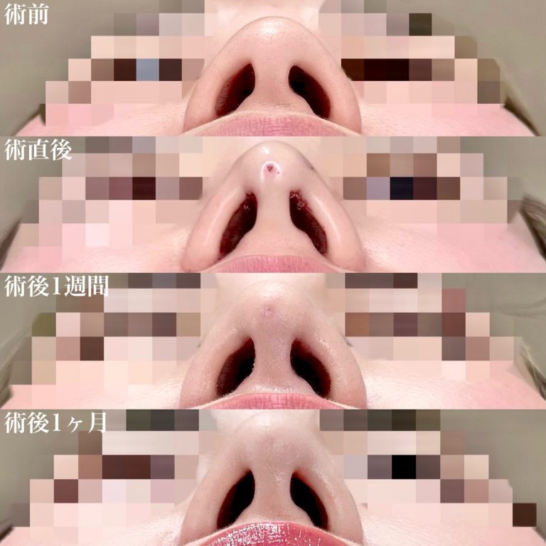 鼻尖形成(担当医:佐藤 直弥 医師)の症例写真2