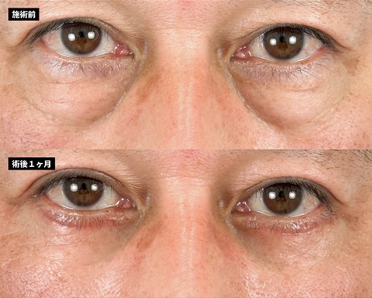 切開法による目の下のたるみ取り（下眼瞼除皺術）(担当医:岡本 卓也 医師)の症例写真1