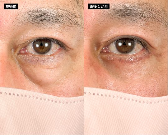 切開法による目の下のたるみ取り（下眼瞼除皺術）(担当医:岡本 卓也 医師)の症例写真3