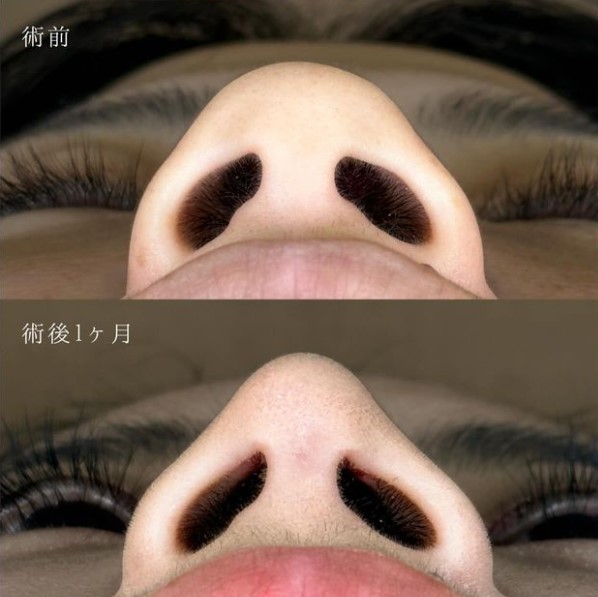 鼻筋・鼻を高くする施術（隆鼻術・ワシ鼻修正・TCBメッシュ）(担当医:岡本 卓也 医師)の症例写真3