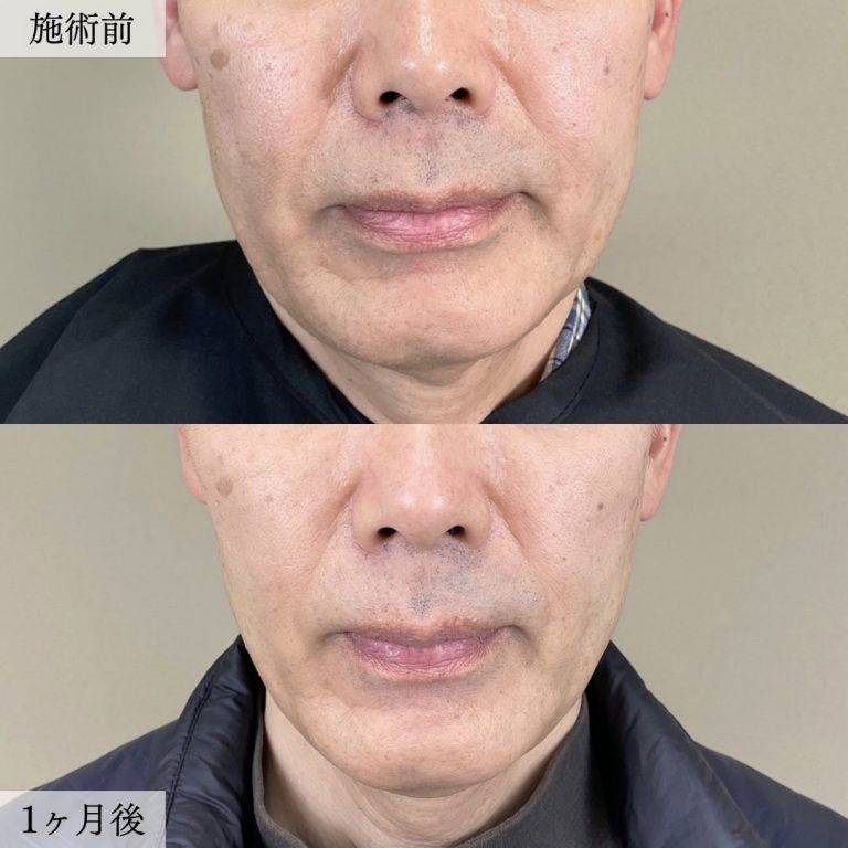 TCB式小顔美肌再生(担当医:大見 貴秀 医師)の症例写真1