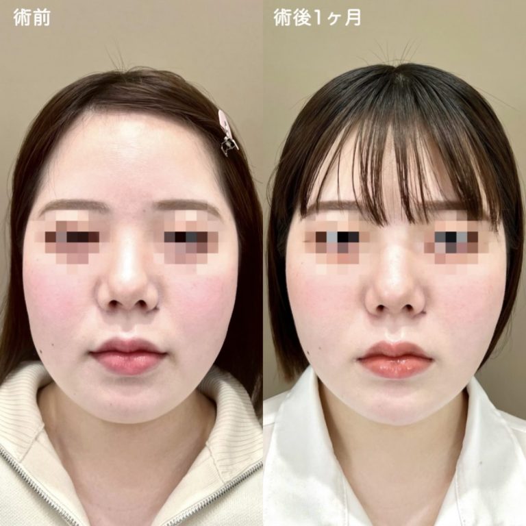 顔の脂肪吸引(担当医:佐藤 直弥 医師)の症例写真1