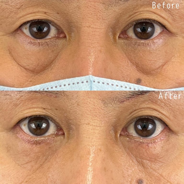 切開法による目の下のたるみ取り（下眼瞼除皺術）(担当医:佐野 孝治 医師)の症例写真1