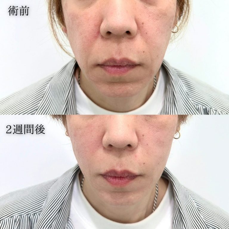 TCB小顔リフト(担当医:三好 翔輝 医師)の症例写真1
