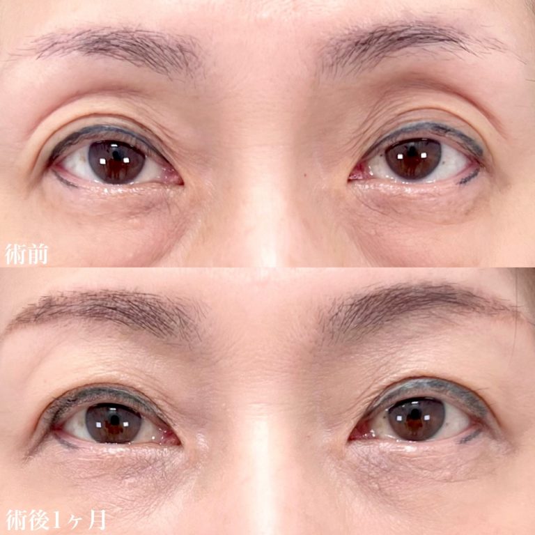 目の上のヒアルロン酸注射(担当医:佐藤 直弥 医師)の症例写真1
