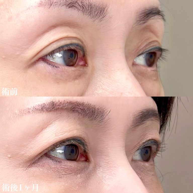 目の上のヒアルロン酸注射(担当医:佐藤 直弥 医師)の症例写真2