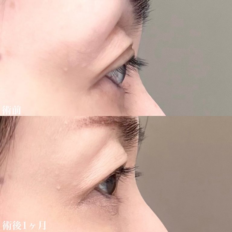 目の上のヒアルロン酸注射(担当医:佐藤 直弥 医師)の症例写真3