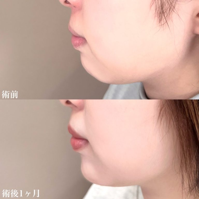 顎（あご）のヒアルロン酸注射(担当医:佐藤 直弥 医師)の症例写真2