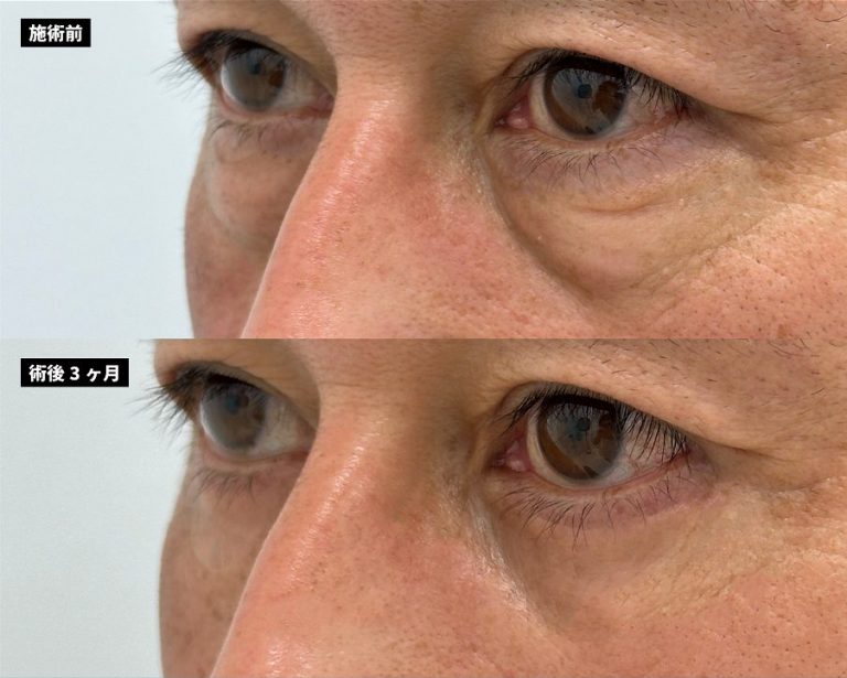 切開法による目の下のたるみ取り（下眼瞼除皺術）(担当医:岡本 卓也 医師)の症例写真2