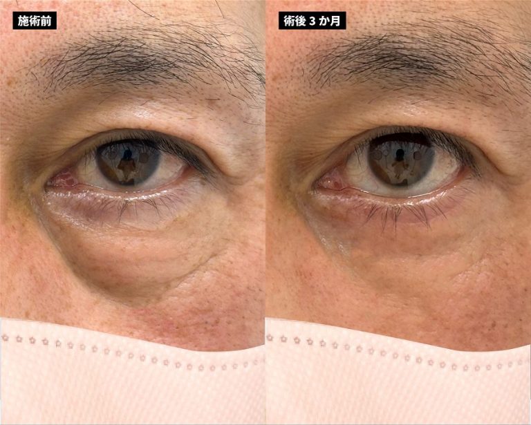 切開法による目の下のたるみ取り（下眼瞼除皺術）(担当医:岡本 卓也 医師)の症例写真3