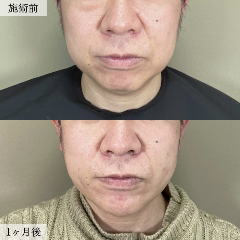 TCB式小顔脂肪吸引(担当医:大見 貴秀 医師)の症例写真1