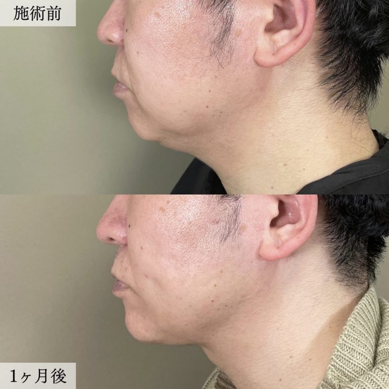 TCB式小顔脂肪吸引(担当医:大見 貴秀 医師)の症例写真2