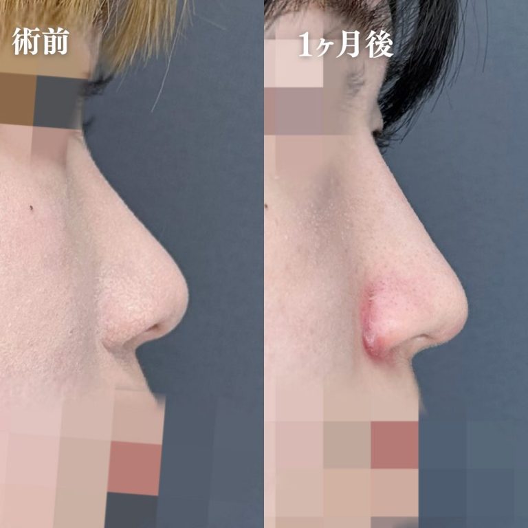 鼻尖形成(担当医:大隈 宏通 医師)の症例写真3