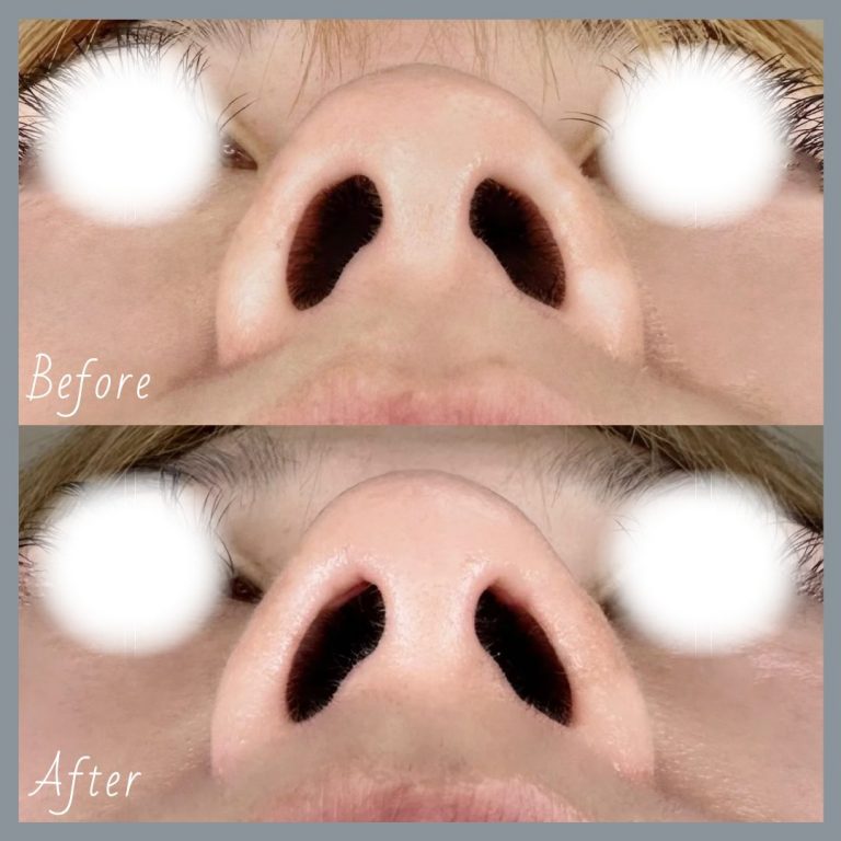 鼻筋・鼻を高くする施術（隆鼻術・ワシ鼻修正・TCBメッシュ）(担当医:串田 大治 医師)の症例写真2