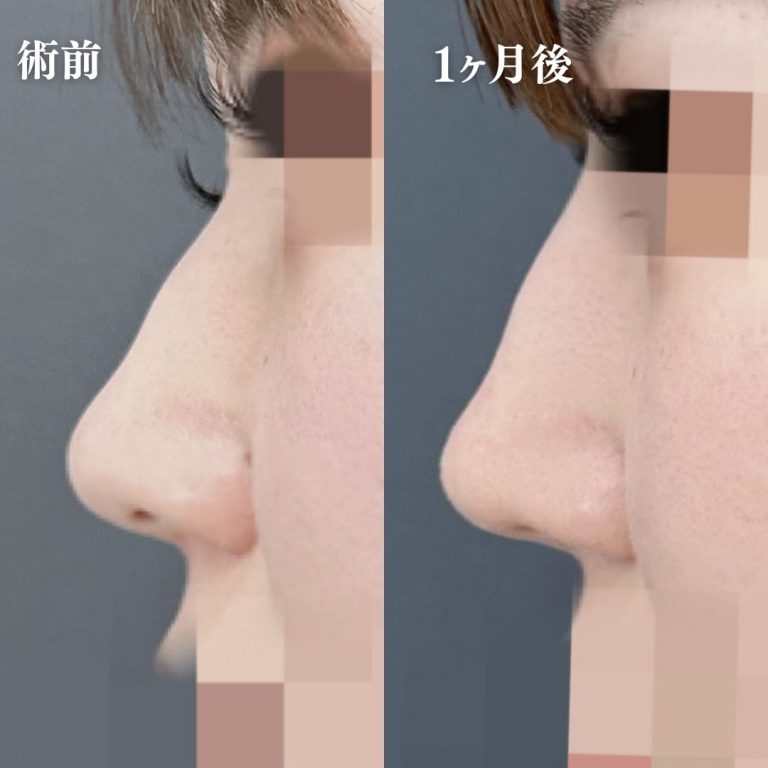 鼻プロテーゼ（隆鼻術）(担当医:大隈 宏通 医師)の症例写真3