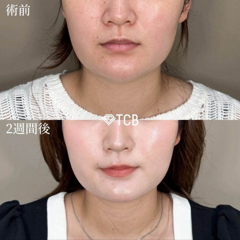 TCB式小顔美肌再生(担当医:安藤 有沙 医師)の症例写真1