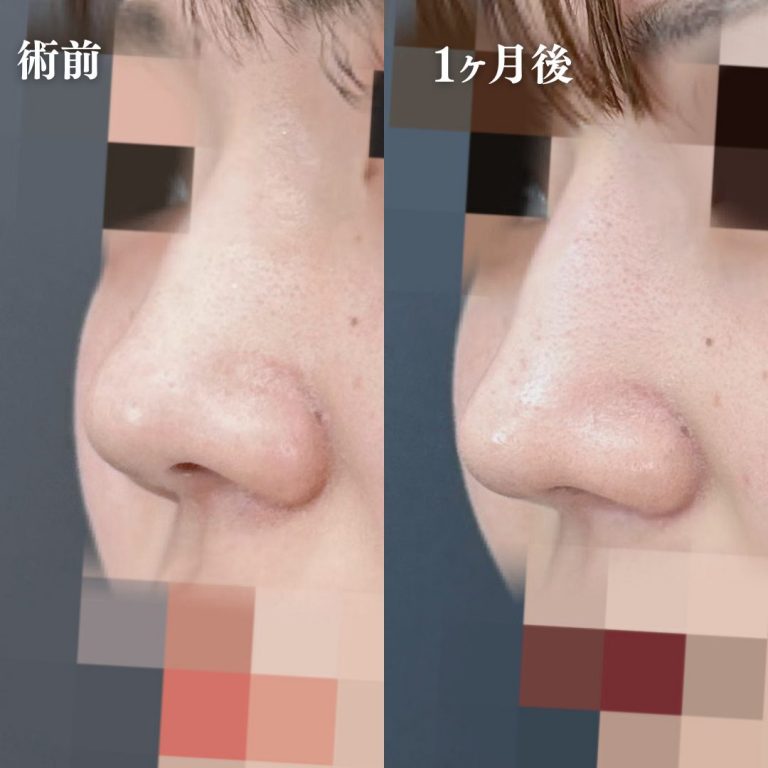 鼻プロテーゼ（隆鼻術）(担当医:大隈 宏通 医師)の症例写真2