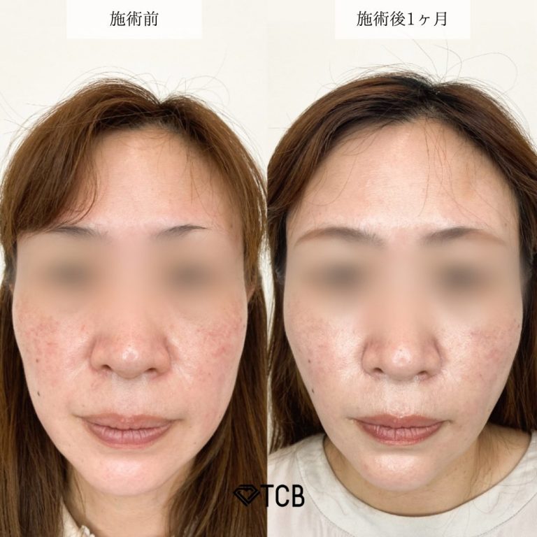 顔の脂肪吸引(担当医:宮﨑 俊行 医師)の症例写真1