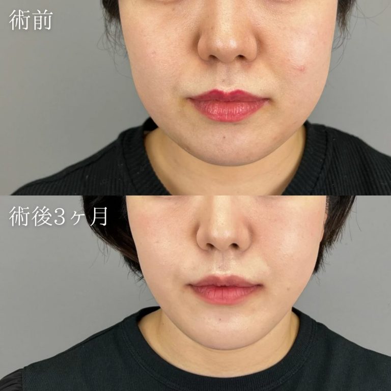 顔の脂肪吸引(担当医:野田 裕太郎 医師)の症例写真1