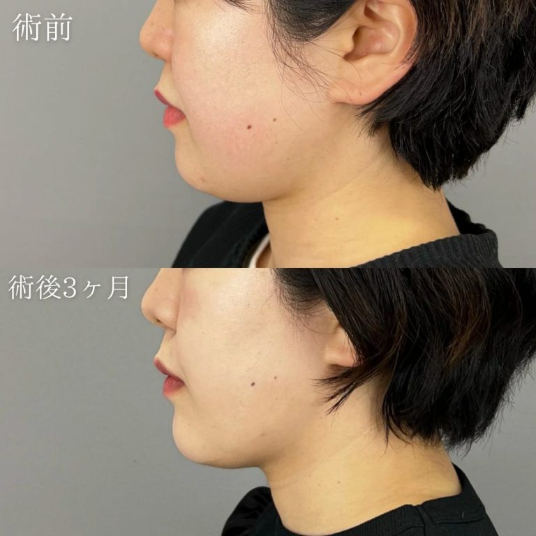 顔の脂肪吸引(担当医:野田 裕太郎 医師)の症例写真2