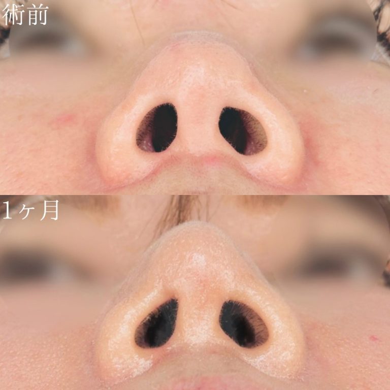 鼻尖形成(担当医:川原田 元亨 医師)の症例写真2