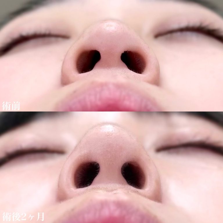 鼻プロテーゼ（隆鼻術）(担当医:佐藤 直弥 医師)の症例写真3