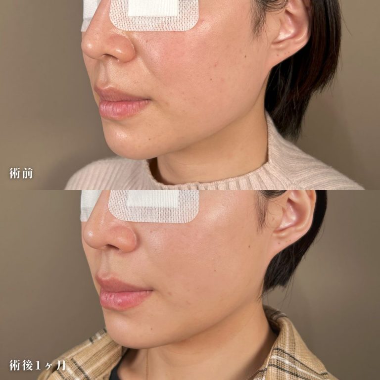 顔の脂肪吸引(担当医:西村 千香 医師)の症例写真2