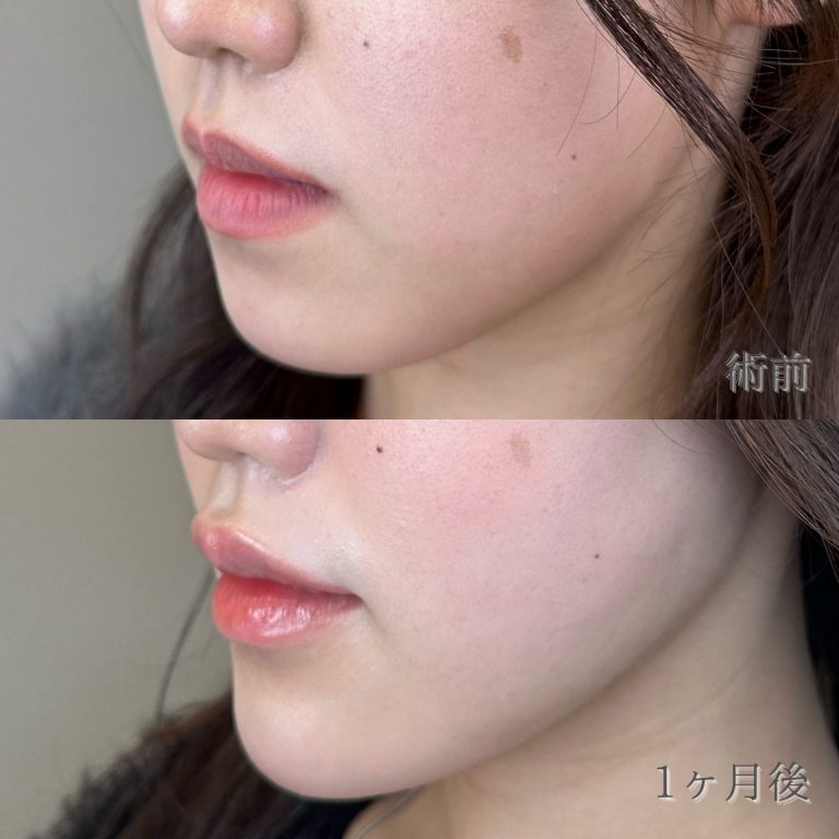 切らない顎形成 3D Eライン(担当医:平尾 聖人 医師)の症例写真2