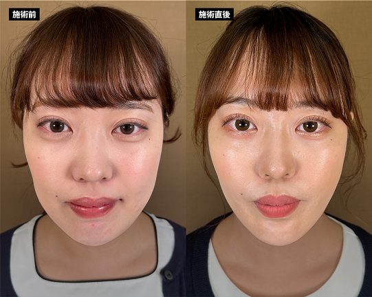 小顔・顔のたるみ・フェイスライン・リフトアップ | 美容整形はTCB東京 