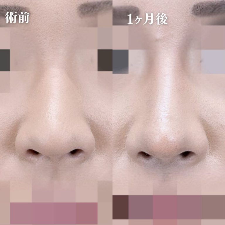 鼻プロテーゼ（隆鼻術）(担当医:大隈 宏通 医師)の症例写真1
