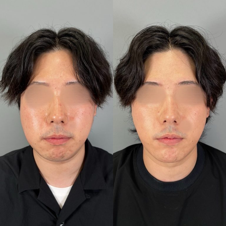 顔の脂肪吸引(担当医:圓田 倫永 医師)の症例写真1