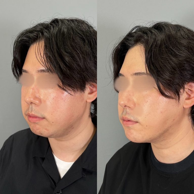 顔の脂肪吸引(担当医:圓田 倫永 医師)の症例写真2