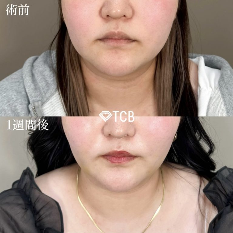 TCB式小顔美肌再生(担当医:安藤 有沙 医師)の症例写真1