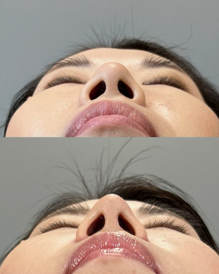 小鼻・鼻の穴を小さくする施術（小鼻縮小術・鼻孔縁挙上）(担当医:圓田 倫永 医師)の症例写真2