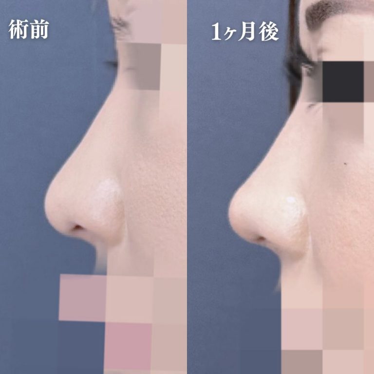 鼻プロテーゼ（隆鼻術）(担当医:大隈 宏通 医師)の症例写真3