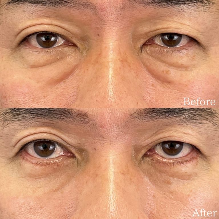 切開法による目の下のたるみ取り（下眼瞼除皺術）(担当医:佐野 孝治 医師)の症例写真1