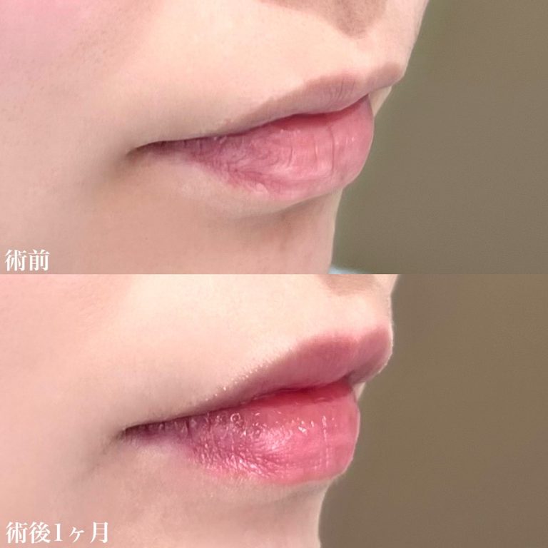 唇のヒアルロン酸注射(担当医:佐藤 直弥 医師)の症例写真1