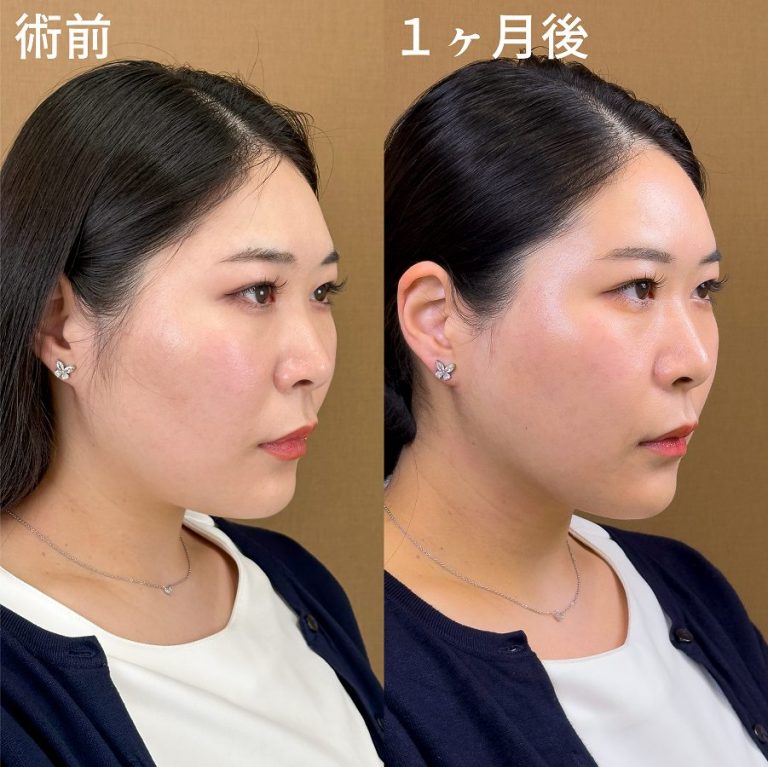 顔の脂肪吸引(担当医:岡本 卓也 医師)の症例写真3