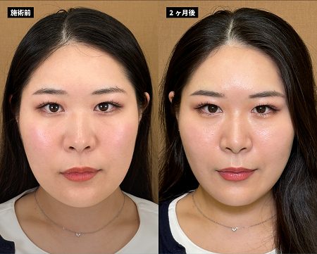顔の脂肪吸引(担当医:岡本 卓也 医師)の症例写真1
