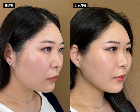 顔の脂肪吸引(担当医:岡本 卓也 医師)の症例写真2