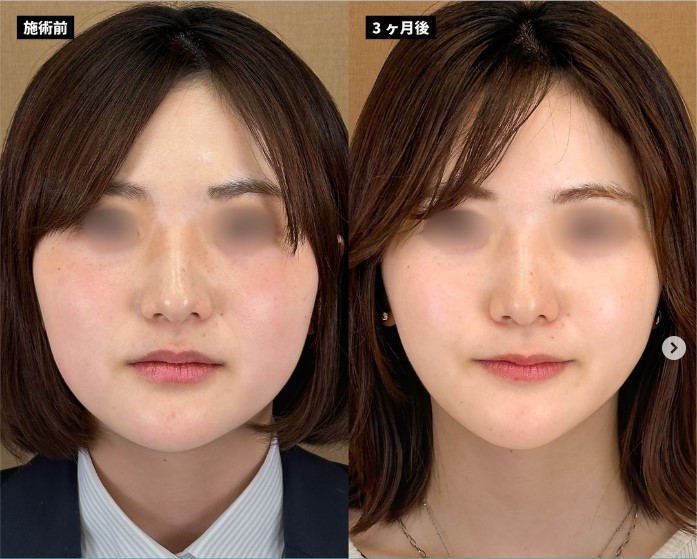 顔の脂肪吸引(担当医:岡本 卓也 医師)の症例写真1