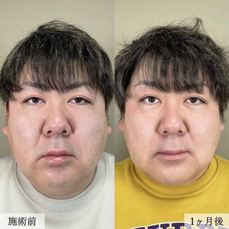 顔の脂肪吸引(担当医:大見 貴秀 医師)の症例写真1
