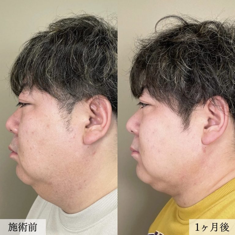 顔の脂肪吸引(担当医:大見 貴秀 医師)の症例写真2