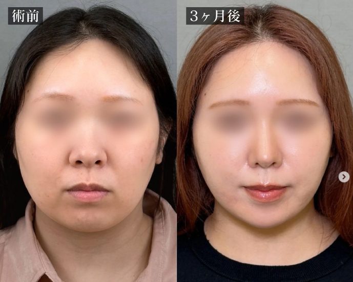 顔の脂肪吸引(担当医:岡本 卓也 医師)の症例写真1