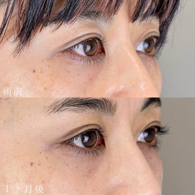 切らない目の下のクマ取り・目の下のたるみ（ふくらみ）取り(担当医:山本 展生 医師)の症例写真1